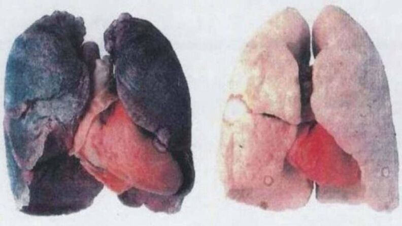 Moitos alcohólicos crónicos morren por danos pulmonares (esquerda)