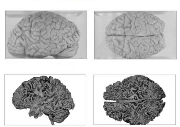 O cerebro dunha persoa sa (arriba) e o cerebro dun alcohólico con consecuencias irreversibles (abaixo)
