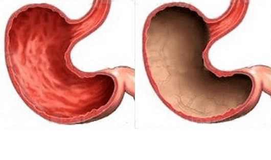 Úlcera, gastrite, cancro e outras patoloxías do estómago (á dereita), cuxa aparición foi causada polo alcohol